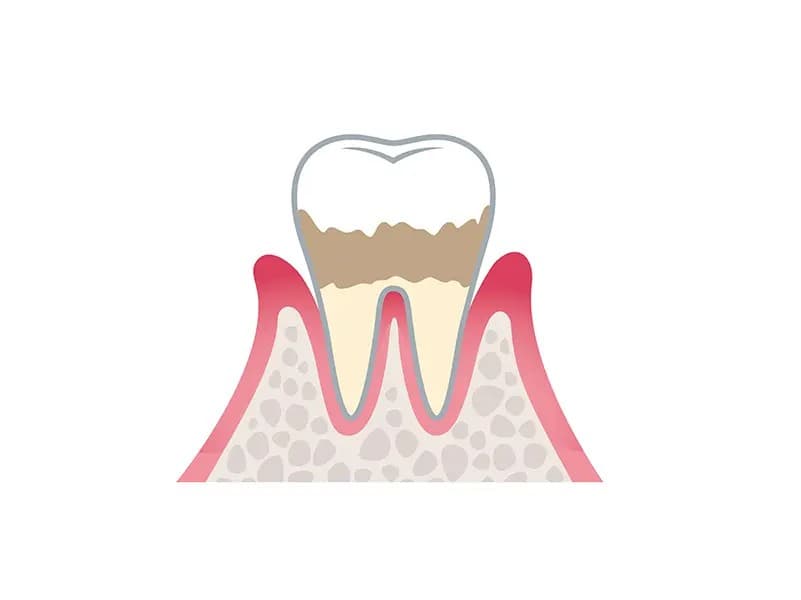 歯周炎（軽度）