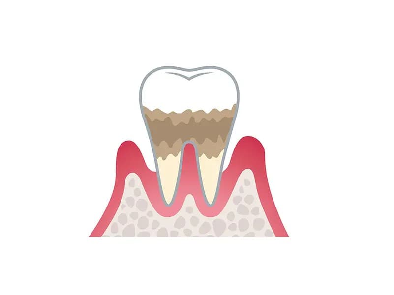 歯周炎（中等度）