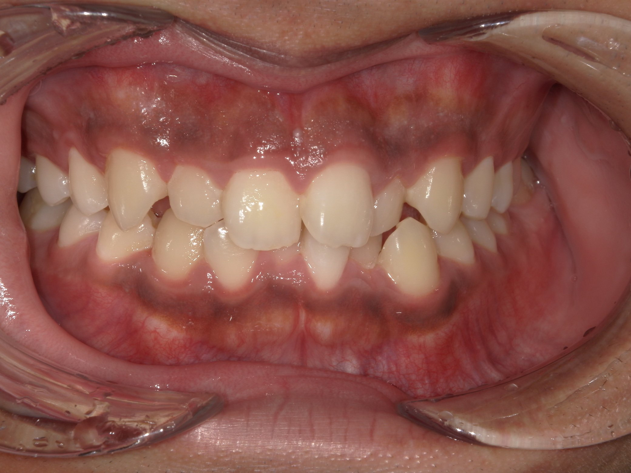 マウスピース矯正 治療前