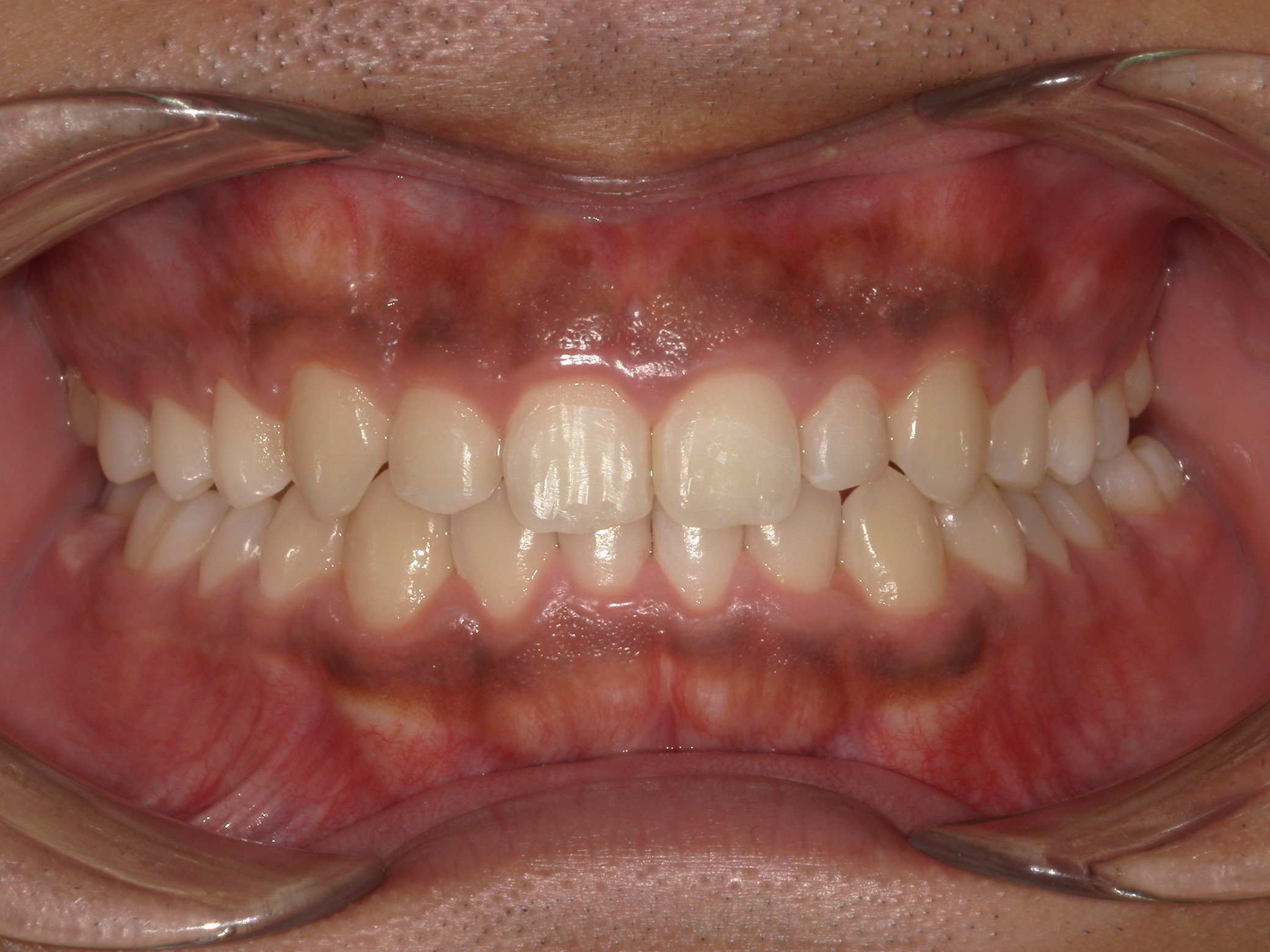 マウスピース矯正 治療後