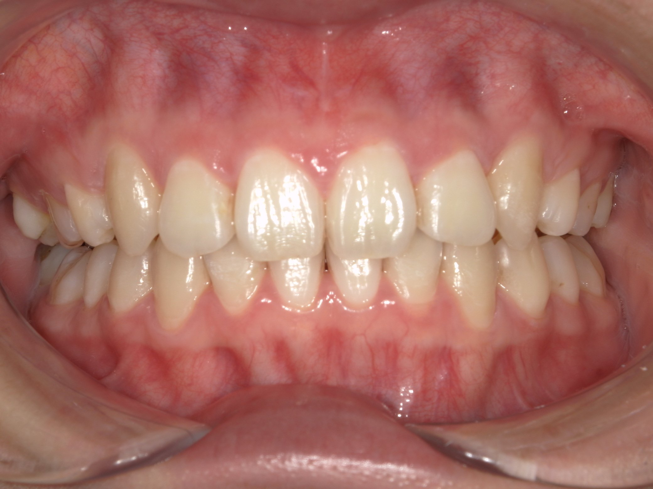 マウスピース矯正 治療後 八重歯 叢生