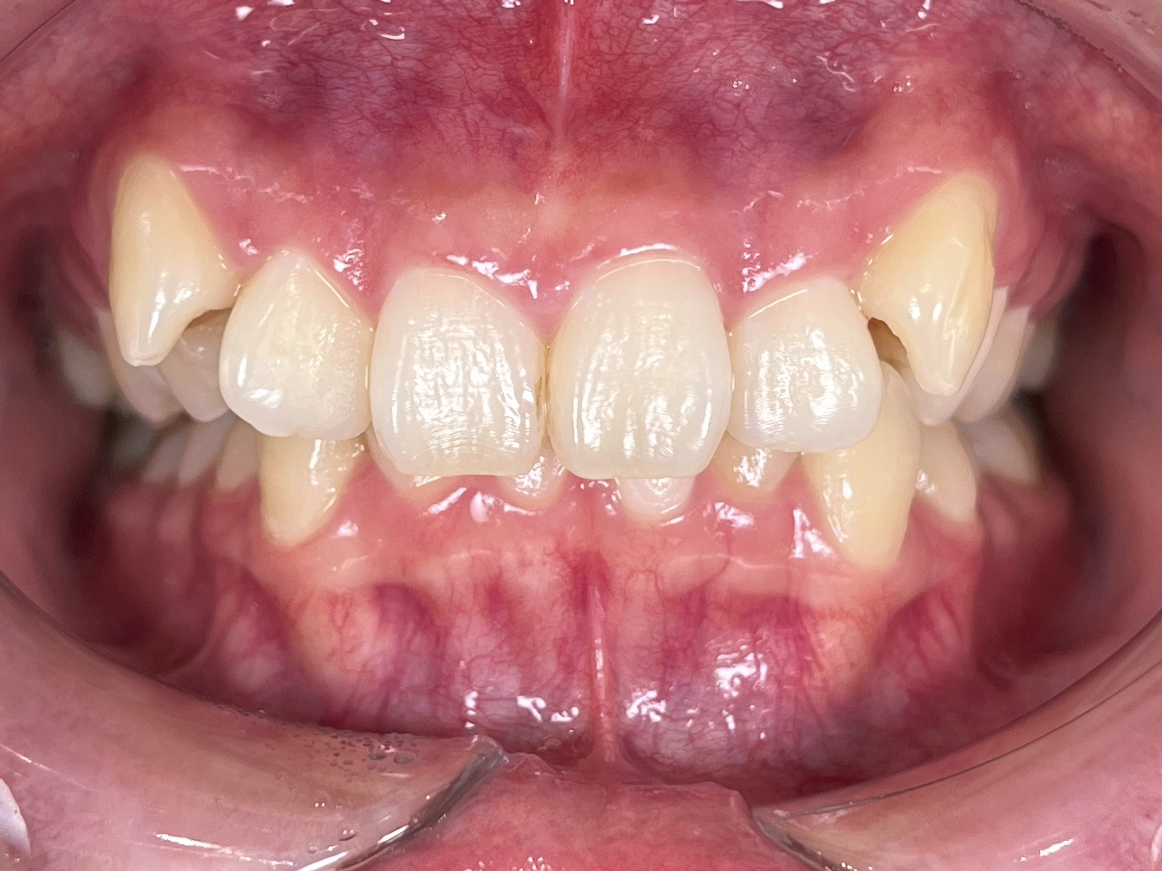 マウスピース矯正 治療前 八重歯 叢生