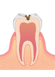 神経を守っている組織のむし歯
